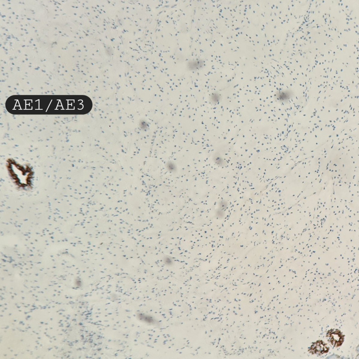 Grunlar cell tumor (Abrikossoff tumor) 🔬

▪️Uncommon breast tumor with peripheral nerve sheath (Schwannian) differentiation
▪️Large epithelioid cells with bland nuclear features and abundant eosinophilic cytoplasm rich in granules
▪️S100 is strongly and diffusely +