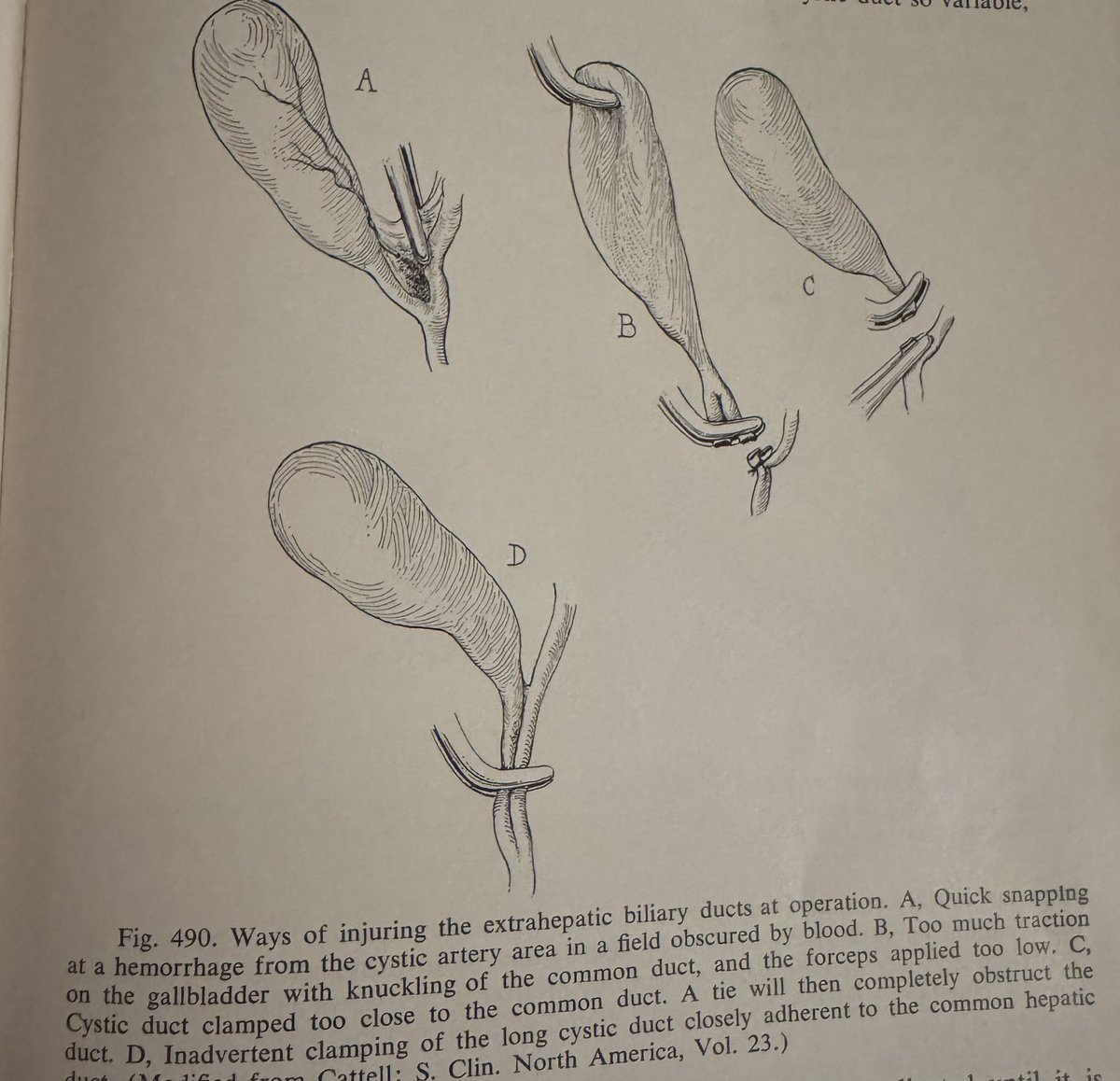 Ways of injuring the bile duct. Circa 1955 Shackelford Surgery of the Alimentary Tract.