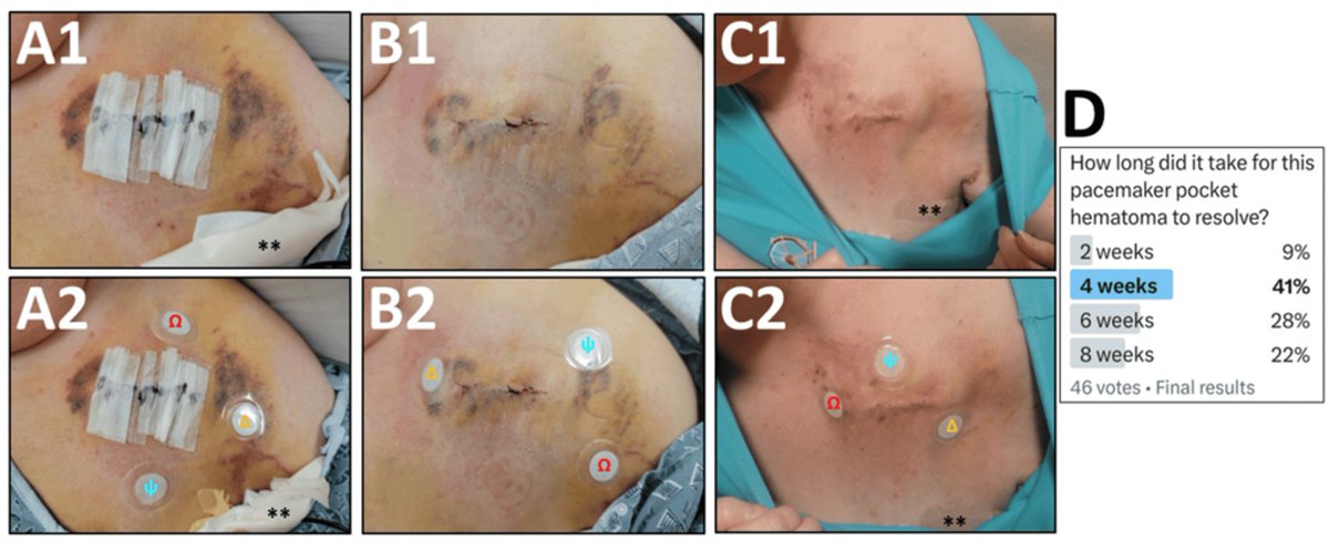 James Kneller, M.D., Ph.D., FHRS (@jamesknellermd) on Twitter photo Cutaneous #phototherapy devices speed up resolution of #pacemaker pocket #hematoma by >500%, cost $40
<a href="/EPeeps_Bot/">EP_Bot</a> #Epeeps #CardioTwitter
<a href="/uazmedphx/">UAZ Medicine - Phoenix</a>
<a href="/uazphxcards/">UAZ Phoenix Cardiology</a>
<a href="/uazresearch/">University of Arizona Research</a>
#dontdisthehis
#WoundCare
<a href="/LifeWaveHealth/">LifeWave Corporate</a>
<a href="/AbbottCardio/">Abbott Cardiovascular</a> <a href="/BIOTRONIK_News/">BIOTRONIK News</a> <a href="/Medtronic/">Medtronic</a> <a href="/BSCCardiology/">BostonSci Cardiology</a> Cutaneous #phototherapy devices speed up resolution of #pacemaker pocket #hematoma by >500%, cost $40
<a href="/EPeeps_Bot/">EP_Bot</a> #Epeeps #CardioTwitter
<a href="/uazmedphx/">UAZ Medicine - Phoenix</a>
<a href="/uazphxcards/">UAZ Phoenix Cardiology</a>
<a href="/uazresearch/">University of Arizona Research</a>
#dontdisthehis
#WoundCare
<a href="/LifeWaveHealth/">LifeWave Corporate</a>
<a href="/AbbottCardio/">Abbott Cardiovascular</a> <a href="/BIOTRONIK_News/">BIOTRONIK News</a> <a href="/Medtronic/">Medtronic</a> <a href="/BSCCardiology/">BostonSci Cardiology</a>