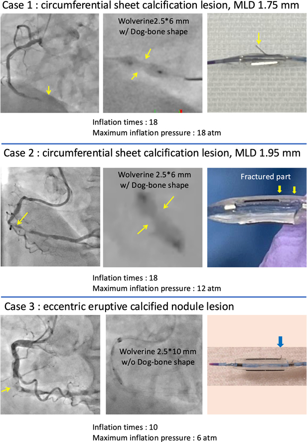 #JACCCaseReports clinical cases suggest that, not only high-pressure dilation of the cutting balloon (CB) to calcified lesions, but also repeated dilation or lesion properties may contribute to CB blade fracture. Interventionalists should be aware. jacc.org/doi/10.1016/j.…