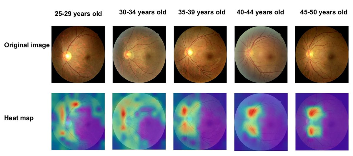 Could Retinal Scans Help Fertility Medicine?

Chinese researchers offer an AI model trained on fundus images to assess reproductive aging and thereby potentially improve women’s healthcare outcomes.
reviewofoptometry.com/article/could-…
#retina #optometry