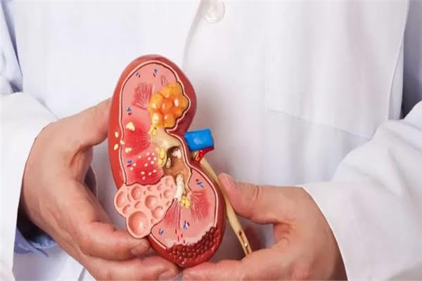 مشروبات طبيعية تساعد في طرد أملاح وحصوات الكلى 