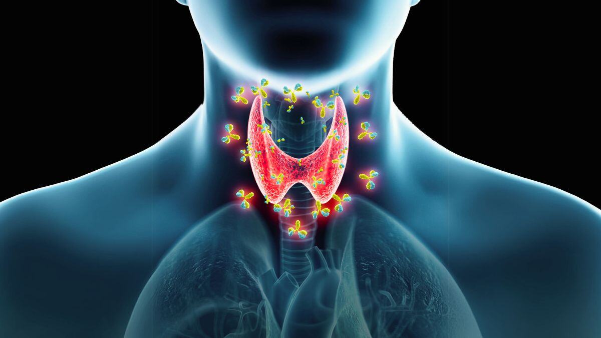 Autoimmunity in Long Covid: Hashimoto's Link

Hashimoto's thyroiditis (HT) is an autoimmune thyroid disorder marked by TPO/Tg antibodies and hypothyroidism.  It co-occurs in ME/CFS and Long Covid with shared HLA genotypes, Th1/Th2 bias, and impaired immune tolerance.