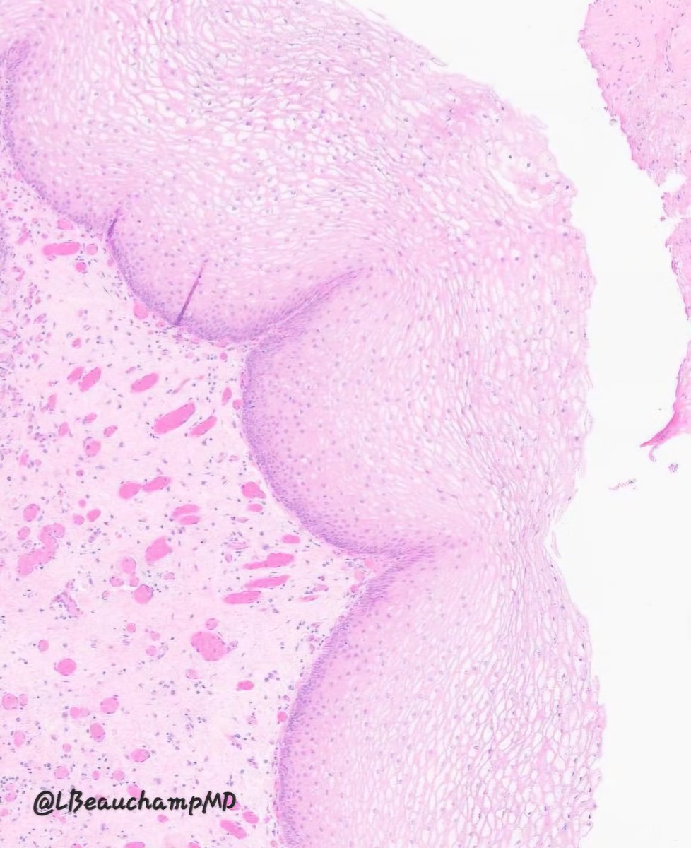 Not all squamous metaplasia is equal.

When found in the bladder, always note whether keratinization is present—non-keratinizing form is more often benign, while keratinizing form raises concern for dysplasia/carcinoma and requires careful follow up. 
#GUPath #PathTwitter #MedEd