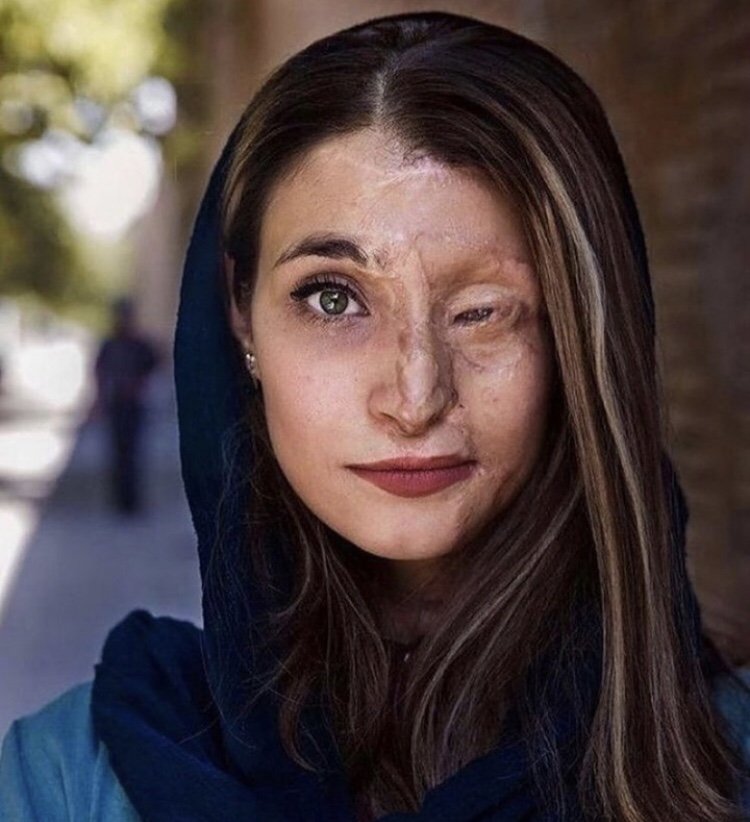 Jim Chimirie 🇬🇧🇮🇱 (@jchimirie66677) on Twitter photo <a href="/realMaalouf/">Dr. Maalouf </a> Marzieh Ebrahimi
Look her in the eye - go on, look. Her scars are not marks of shame; they are the brutal handwriting of a regime that fears women who live freely. Disfigured? No. She is not disfigured. She is transfigured - into a symbol of defiance, dignity, and unbreakable <a href="/realMaalouf/">Dr. Maalouf </a> Marzieh Ebrahimi
Look her in the eye - go on, look. Her scars are not marks of shame; they are the brutal handwriting of a regime that fears women who live freely. Disfigured? No. She is not disfigured. She is transfigured - into a symbol of defiance, dignity, and unbreakable