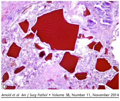 I can't really explain why it looks so much like Sevelamer. According to this paper by <a href="/MArnold_PedPath/">Michael Arnold, MD, PhD</a>, BASs should be homogeneous.
pubmed.ncbi.nlm.nih.gov/24921636/

However, it does say that  it can show fracture lines which may resemble fishscales. 👇