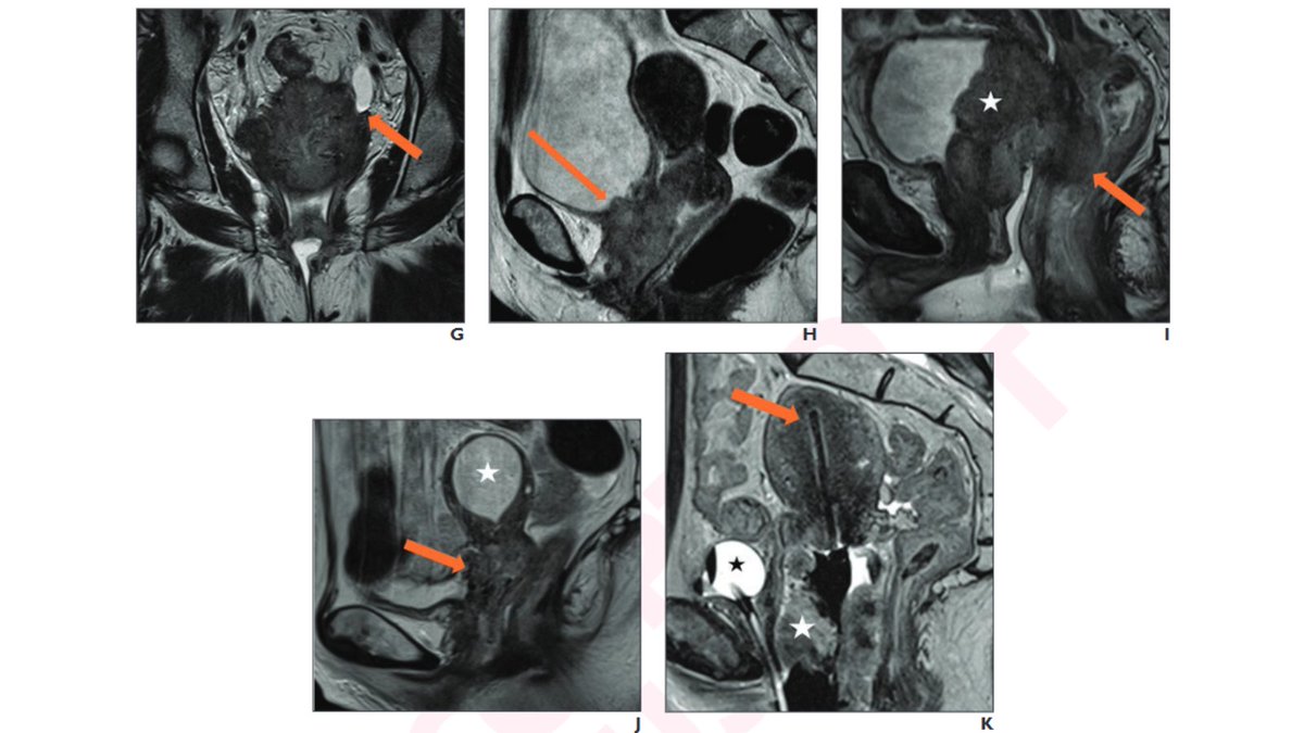 New <a href="/AJR_Radiology/">AJR</a> Accepted Manuscript:

"Cervical Cancer Reporting Lexicon: A Collaboration by the SAR Uterine and Ovarian Cancer DFP, ESUR Female Pelvic Imaging Working Group, and Asian Society of Abdominal Radiology"

By Dr Roller &amp; team 

ajronline.org/doi/10.2214/AJ…