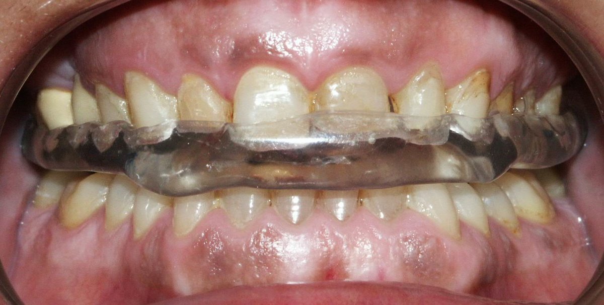 OviDentalGo's tweet photo. 👉 Férula de relajación o Michigan
* Indicada en casos de bruxismo y TTM, permite un contacto oclusal uniforme, facilitando la relajación muscular y la desprogramación mandibular.
#Bruxismo #Féruladedescarga #Férulademichigan #Oclusión #Medent #Ovidental https://t.co/zAWum66qDd