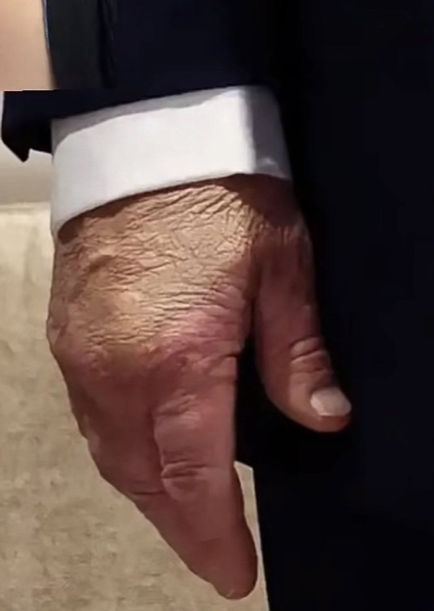 JoJoFromJerz's tweet image. Why is Donald Trump covering bruises on his hands with cake makeup and why isn’t anyone in the press asking him about it?