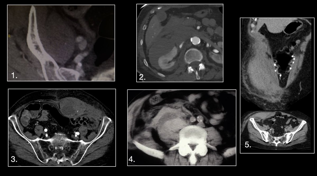Not all Abdominal hematomas are equal!  What are these?