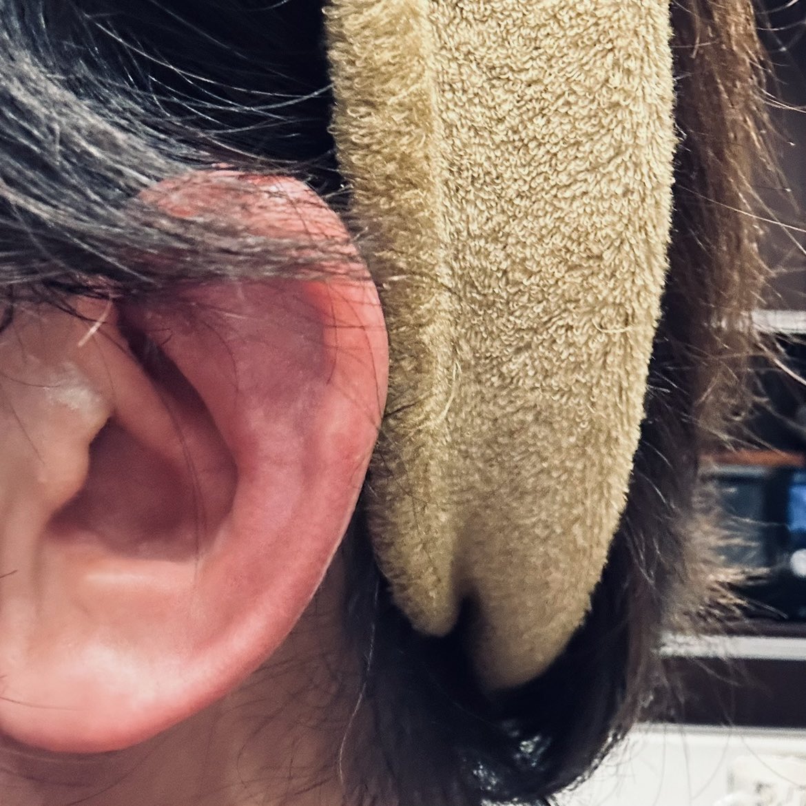 左耳がめっちゃ腫れてチョー痛い！👂､､､触れると激痛すぎて寝る時に左向けないし髪の毛ボサボサなのに美容院もお預け🐶

母の介護中にもあった症状､､､何だこれ？､､､もう4週間､､､なんだろ？

何でもないことを祈り🙏面倒なので見てみぬふりをしよう✌️､､､日本人ぽい？