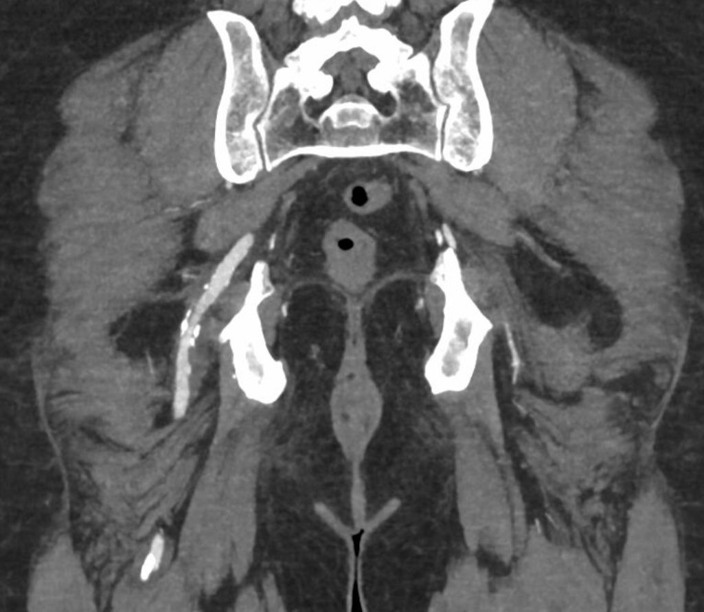drvenkimdrd's tweet image. Persistent Sciatic artery 🌟🌟