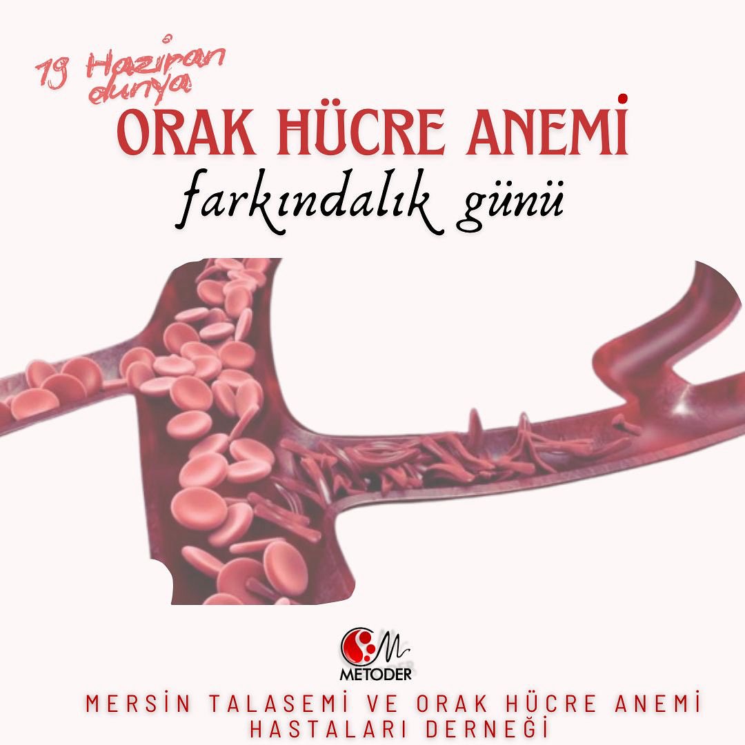 19 HAZIRAN 
DÜNYA ORAK HÜCRELi ANEMi
FARKINDALIK GÜNÜ
Orak Hücre Anemisi, kirmizi kan hücrelerinde azalma. pigment safra taslari, agrili ve damarlari tikayan krizlerle seyreden bir hastaliktir.
#OrakHücreAnemisi
#OrakHücre
#talasemi
#akdenizanemisi
#metoder_33