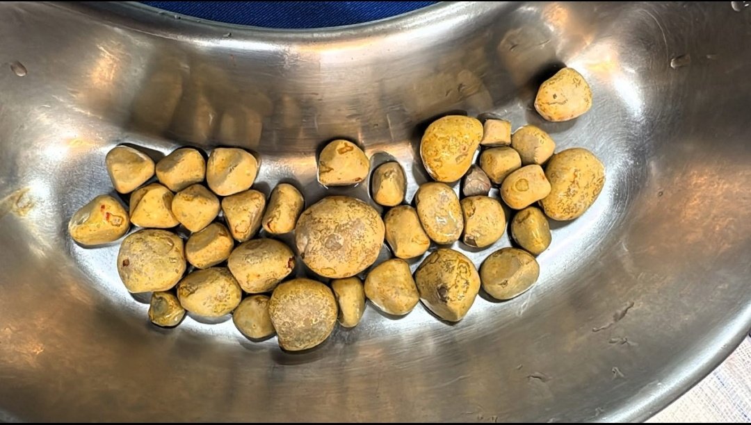 Lavish0009's tweet photo. 🚨 "इतनी कोक पी कि डॉक्टर भी दंग रह गए – 35 STONES!"

ब्राज़ील में एक शख्स रोज़ 3 लीटर Coca-Cola पीता था —
💥 नतीजा: ऑपरेशन में ब्लैडर से निकले 35 पत्थर!

👨‍⚕️ डॉक्टर बोले: “ऐसा केस 11 साल में पहली बार देखा…”
#HealthAlert #CocaCola #BladderStones #ViralNews #DrinkWaterNotSoda https://t.co/80oQwr36Tu