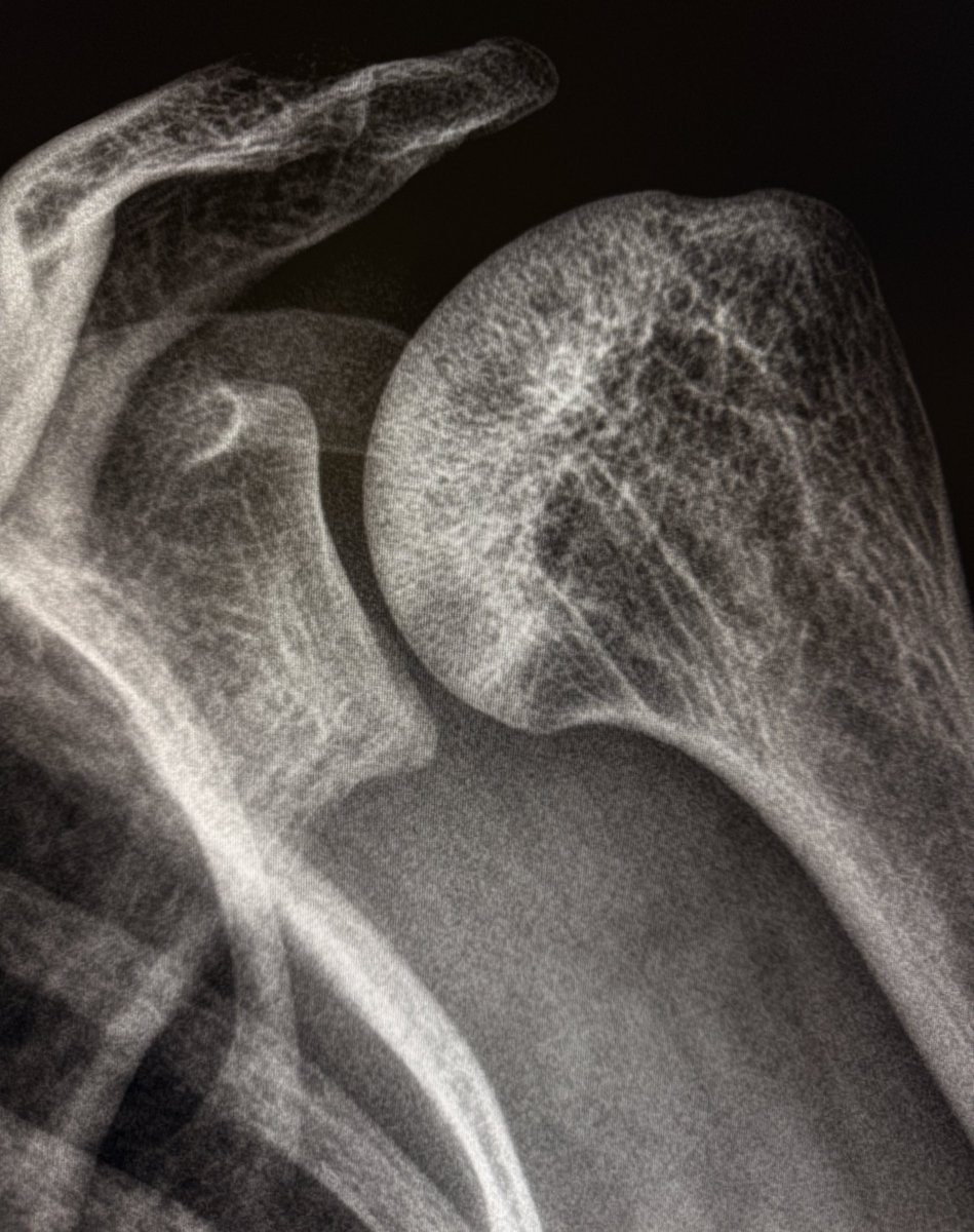 Nothing fancy today! 

This is just a nice example of the “Snowcap sign” of AVN of the humeral heads (bilateral) on radiographs. 

The sclerotic, dense necrotic bone beneath a preserved articular surface resembles a snow-covered mountain peak, a deceptive summit above a crumbling
