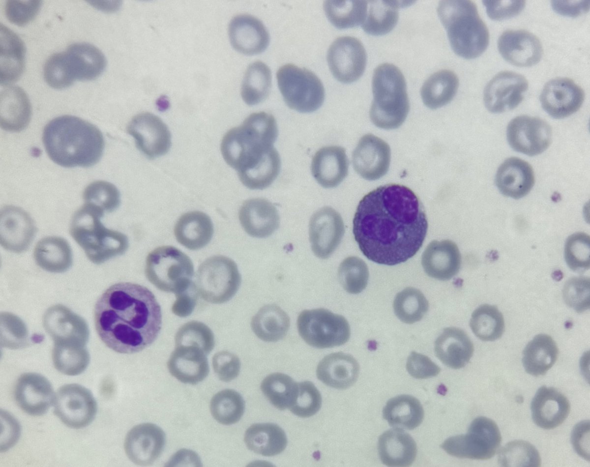 Drmona1995's tweet photo. 🎧👀EOSINOPHIL 👀 🎧
12–17 µm
Nucleus: Bilobed nucleus (“spectacle” or “eyeglass”).
Cytoplasm:Packed with large, coarse, refractile eosinophilic (orange) granules.Granules are uniform in size and stain with acidic dyes
#pathX #pathmed #pathology2025 https://t.co/su7FvPW0Sk