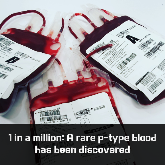 shinO7_O7's tweet photo. 🩸 1 in a million: A rare p-type blood has been discovered in Yunnan, China — first in 570,000 donors!
📍This ultra-rare type can't be detected by standard ABO/Rh tests
⚠️ Estimated frequency: <0.0001%
🔬 Only ~12 people known in China
#RareBloodType #PtypeBlood #Genetics #MedicalDiscovery #BloodScience