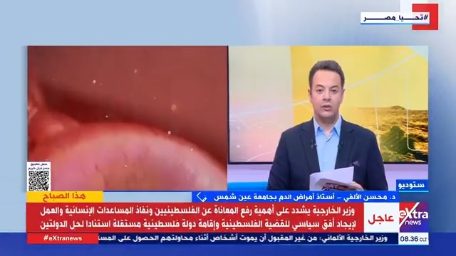 د.محسن الألفي أستاذ أمراض الدم بجامعة القاهرة: التبرع بالدم هو العلاج الأساسي لمرضى الأنيميا المنجلية ومرضى أنيميا البحر المتوسط #رامي_الحلواني د.محسن الألفي أستاذ أمراض الدم بجامعة القاهرة: التبرع بالدم هو العلاج الأساسي لمرضى الأنيميا المنجلية ومرضى أنيميا البحر المتوسط #رامي_الحلواني