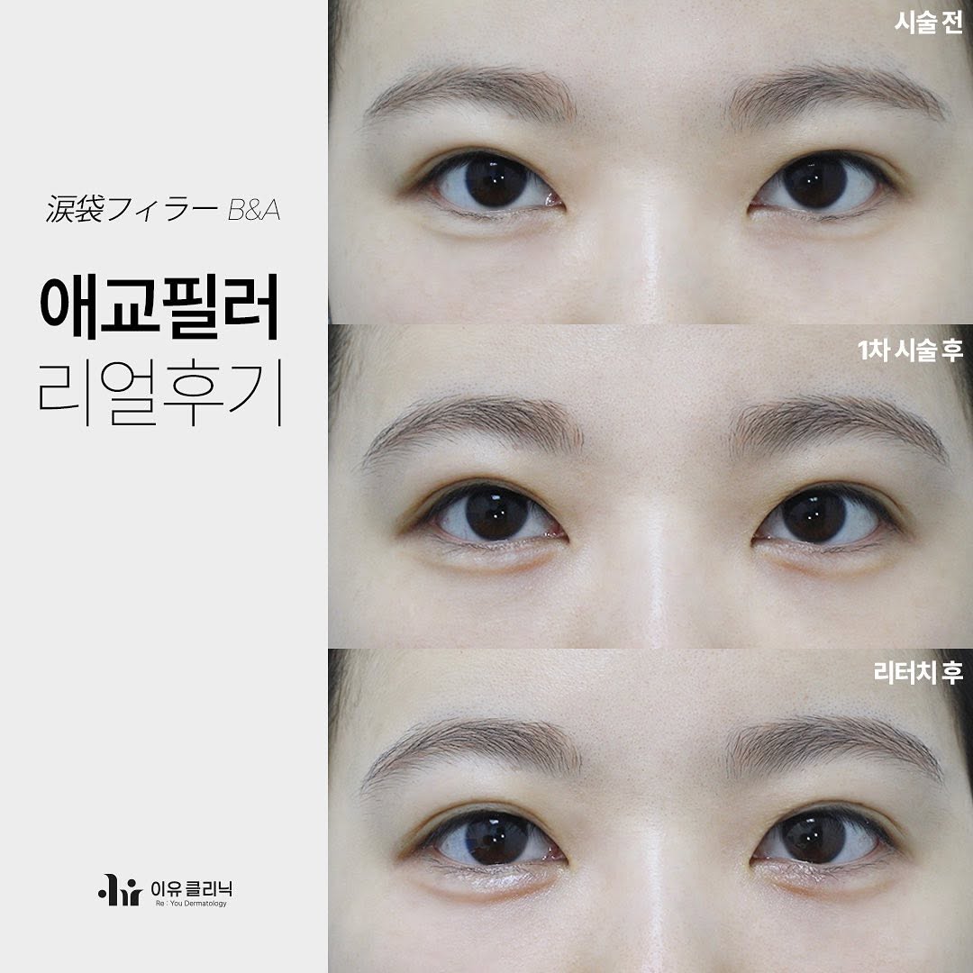 Moongaohan's tweet photo. 💎為什麼臥蠶是“桃花眼”的靈魂？
微笑時如月牙般綻放，瞬間放大雙眼、縮短中庭，打造“楚楚可憐”的甜系少女感！✨

🌈 誰適合玻尿酸臥蠶？
❤ 先天臥蠶扁平或不對稱者；
❤ 中庭較長、希望視覺“減齡”者；
❤ 搭配眼瞼下至術，打造“狗狗眼”極致氛圍110！

💕LINE:reyoucl
💕中文室長Wechat:Y415L420 https://t.co/r3TENuxXT9