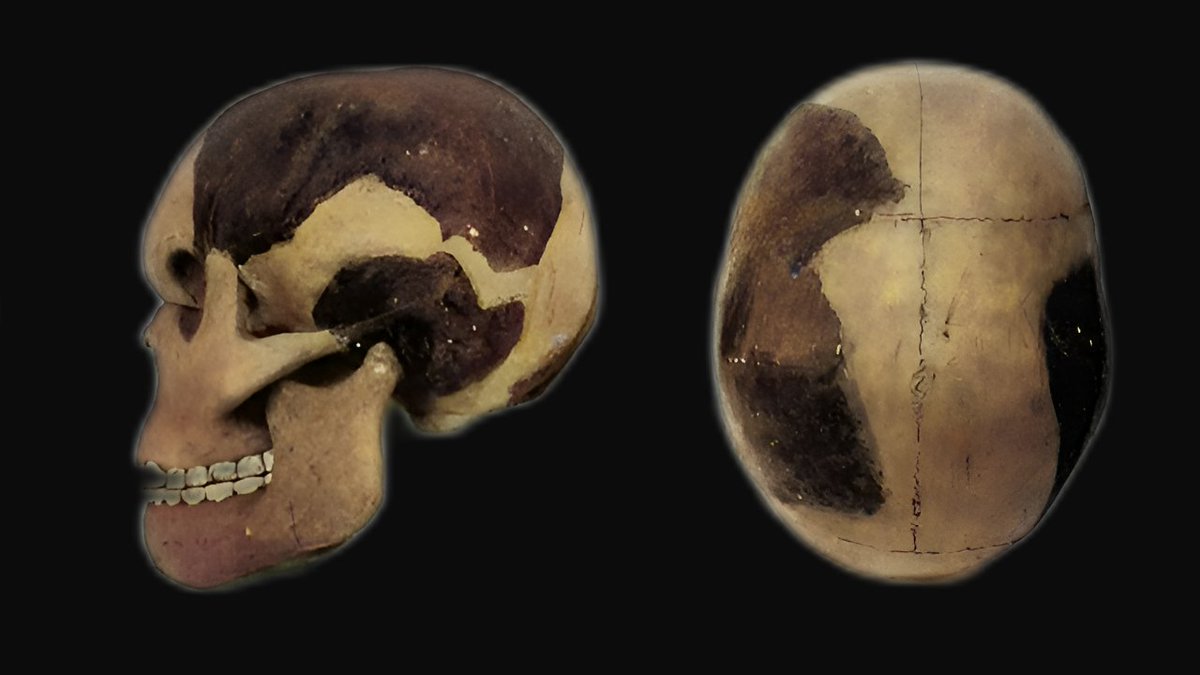 highlycited's tweet image. Piltdown Man by Arthur Keith 1913.  Remarkably, Keith seemed to know this was a fraud but didn&apos;t want to expose his friend Dr. Smith-Woodward.    His skull reconstruction was completely different than the Apeman created by Smith-Woodward.
