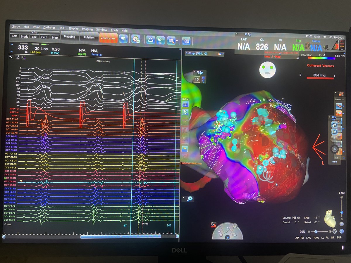Having received training in the S3 mapping for VT at Clinic Barcelona, one of the leading centers in Europe, we are pleased to implemented this technique in our clinic under the supervision of <a href="/YalinKivanc/">Kıvanç YALIN</a> . We look forward to future collaborations <a href="/ivroca/">Ivo Roca, FEHRA, FESC</a> <a href="/aportasanchez/">Andreu Porta Sánchez</a>