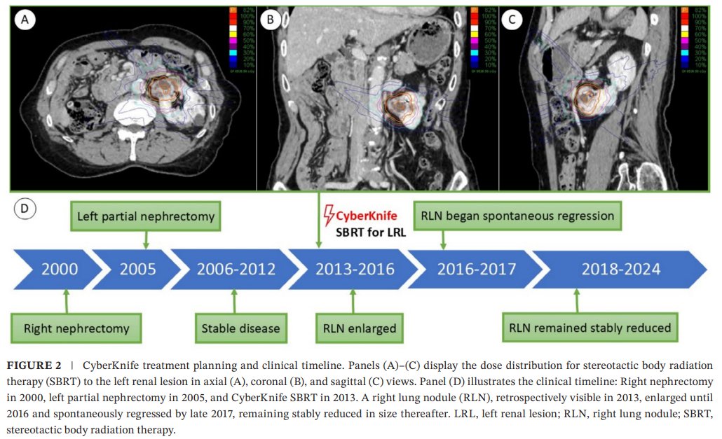 An interesting cast study demonstrating the potential of SBRT to induce a systemic abscopal response in metastatic RCC 
pubmed.ncbi.nlm.nih.gov/40341814/

#CyberKnife #KidneyCancerDay