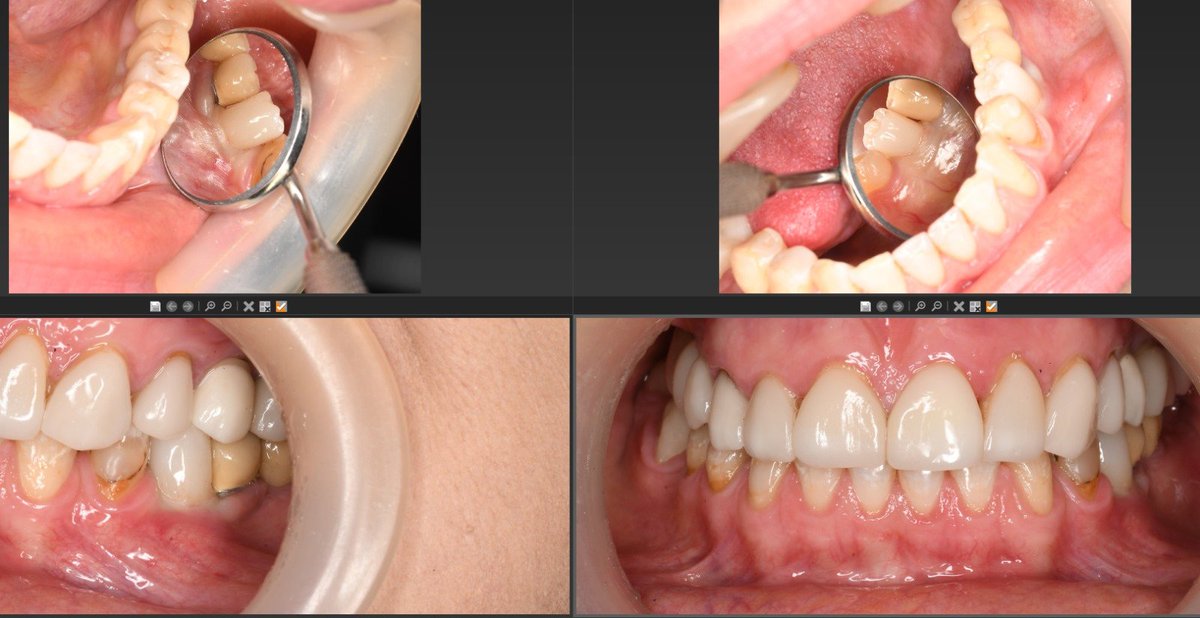 Jesteśmy tak zadowoleni z wyników ostatnich zabiegów implantologicznych w stomatologii z wykorzystaniem naszego hydrożelu, że postanowiłem wrzucić dodatkowe zdjęcie (już bez krwi).
Tak wygląda miejsce zabiegu po 5 miesiącach od usunięcia zęba, jednoczesnego zamocowania śruby