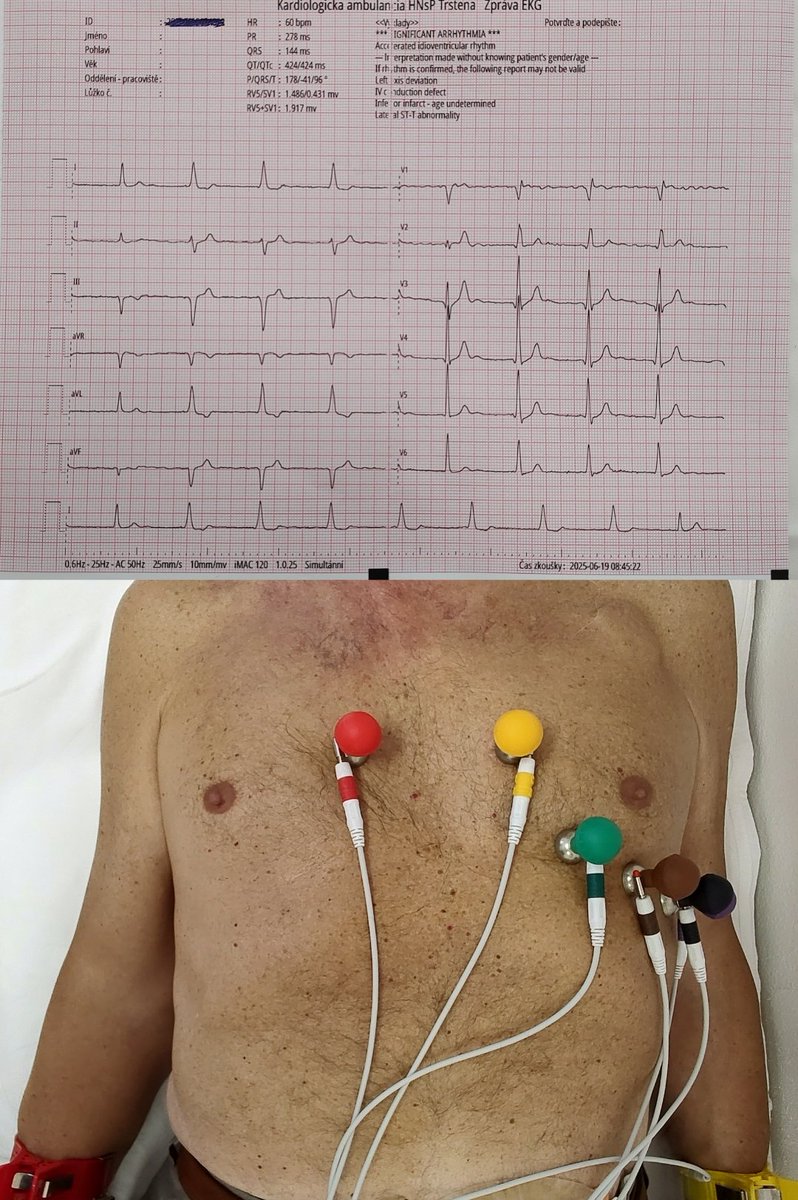 Milan Koštek (@kostekmilan) on Twitter photo Standard chest lead placement. No spikes to be seen. Qr in V1. See the next step in the following subthread trying to gain more Qr complexes it even see the spikes. <a href="/curilakarol/">curilakarol</a> <a href="/enes_elvin/">Enes Elvin Gul, MD, FESC, FEHRA</a> Standard chest lead placement. No spikes to be seen. Qr in V1. See the next step in the following subthread trying to gain more Qr complexes it even see the spikes. <a href="/curilakarol/">curilakarol</a> <a href="/enes_elvin/">Enes Elvin Gul, MD, FESC, FEHRA</a>