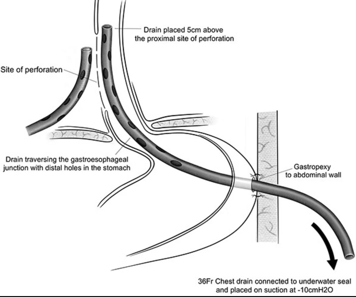 ✅ This is smart !
✅ Vacuum therapy for esophageal perforations through the stomach
👍🏻 Life saving intervention that can be done anywhere in the 🗺️
📦 Thinking outside the box 👍🏻