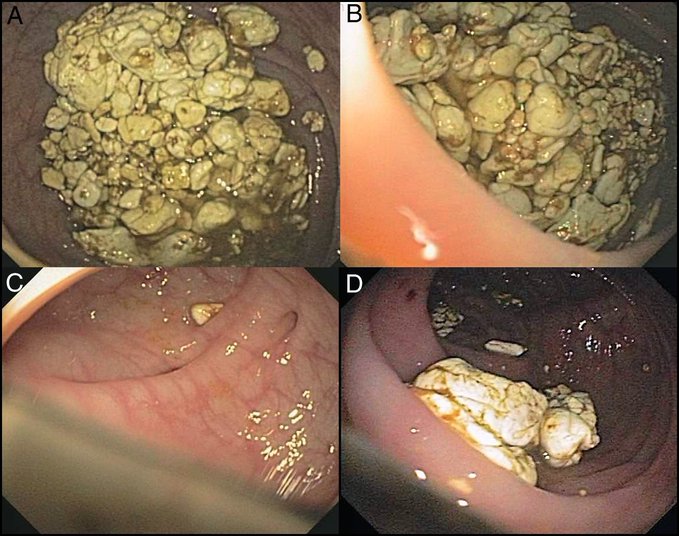 🧠 ¿Recuerdas cuando te decían que no te tragaras el chicle porque “se te iba a quedar pegado”?
Pues… no estaban tan lejos de la realidad.

📍Este es el caso real de un paciente que consultó por síntomas digestivos persistentes. Durante la colonoscopia, se identificaron