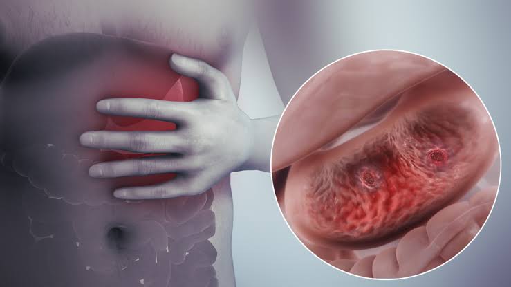 Asexual Doctor (@choji_es) on Twitter photo <a href="/momentumHCare/">Momentum Healthcare</a> So, what causes that wound?
✍️H. pylori bacteria – This stubborn germ lives in many people’s stomachs and can damage the lining over time.
✍️Painkillers abuse – Taking ibuprofen, aspirin, or some herbal drugs anyhow damages the stomach wall.
✍️Smoking and heavy alcohol <a href="/momentumHCare/">Momentum Healthcare</a> So, what causes that wound?
✍️H. pylori bacteria – This stubborn germ lives in many people’s stomachs and can damage the lining over time.
✍️Painkillers abuse – Taking ibuprofen, aspirin, or some herbal drugs anyhow damages the stomach wall.
✍️Smoking and heavy alcohol