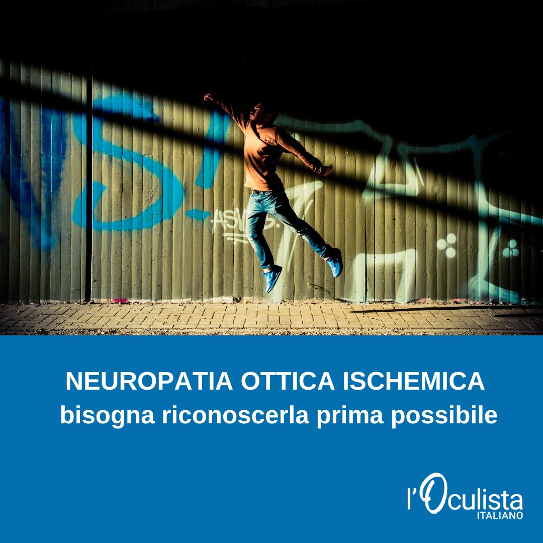 La neuropatia ottica ischemica anteriore è una patologia grave, che può insorgere improvvisamente e se non viene diagnosticata e gestita tempestivamente può pregiudicare in maniera seria e definitiva la vista.  Per approfondire oculistaitaliano.it/articoli/neuro…