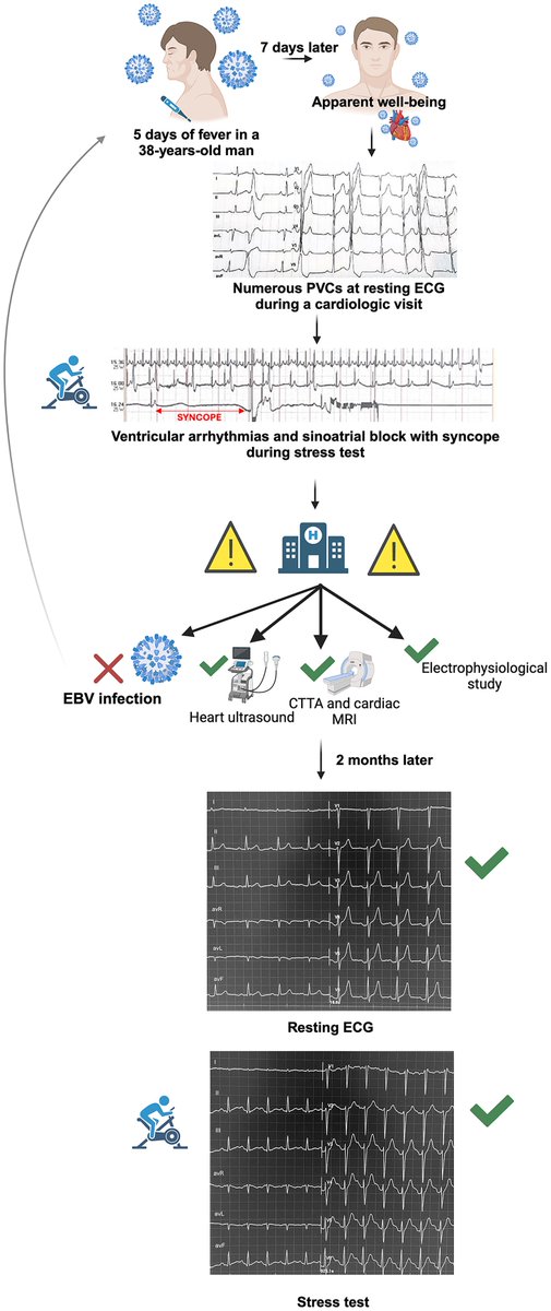 European Society of Cardiology Journals (@esc_journals) on Twitter photo Sinus arrest and syncope in a young patient with Epstein–Barr virus infection: a case report. ow.ly/ojBG50W5iGQ
#EHJCaseReports <a href="/Phiso_de/">Philipp Sommer</a> <a href="/TJ_Yeo/">Tee Joo YEO</a> <a href="/aayshacader/">Aaysha Cader</a> <a href="/BoldiKovacsMD/">Boldizsar Kovacs</a> <a href="/KardiologieHH/">Erik Rafflenbeul</a> <a href="/ANazmiCalik/">A.Nazmi Calik</a> <a href="/O_Azizy_MD/">Obayda Azizy</a> <a href="/saramoscatelli7/">Sara Moscatelli</a> <a href="/EHJCREiC/">EHJCaseReports Editor-in-Chief</a> #CardioX #EPeeps Sinus arrest and syncope in a young patient with Epstein–Barr virus infection: a case report. ow.ly/ojBG50W5iGQ
#EHJCaseReports <a href="/Phiso_de/">Philipp Sommer</a> <a href="/TJ_Yeo/">Tee Joo YEO</a> <a href="/aayshacader/">Aaysha Cader</a> <a href="/BoldiKovacsMD/">Boldizsar Kovacs</a> <a href="/KardiologieHH/">Erik Rafflenbeul</a> <a href="/ANazmiCalik/">A.Nazmi Calik</a> <a href="/O_Azizy_MD/">Obayda Azizy</a> <a href="/saramoscatelli7/">Sara Moscatelli</a> <a href="/EHJCREiC/">EHJCaseReports Editor-in-Chief</a> #CardioX #EPeeps