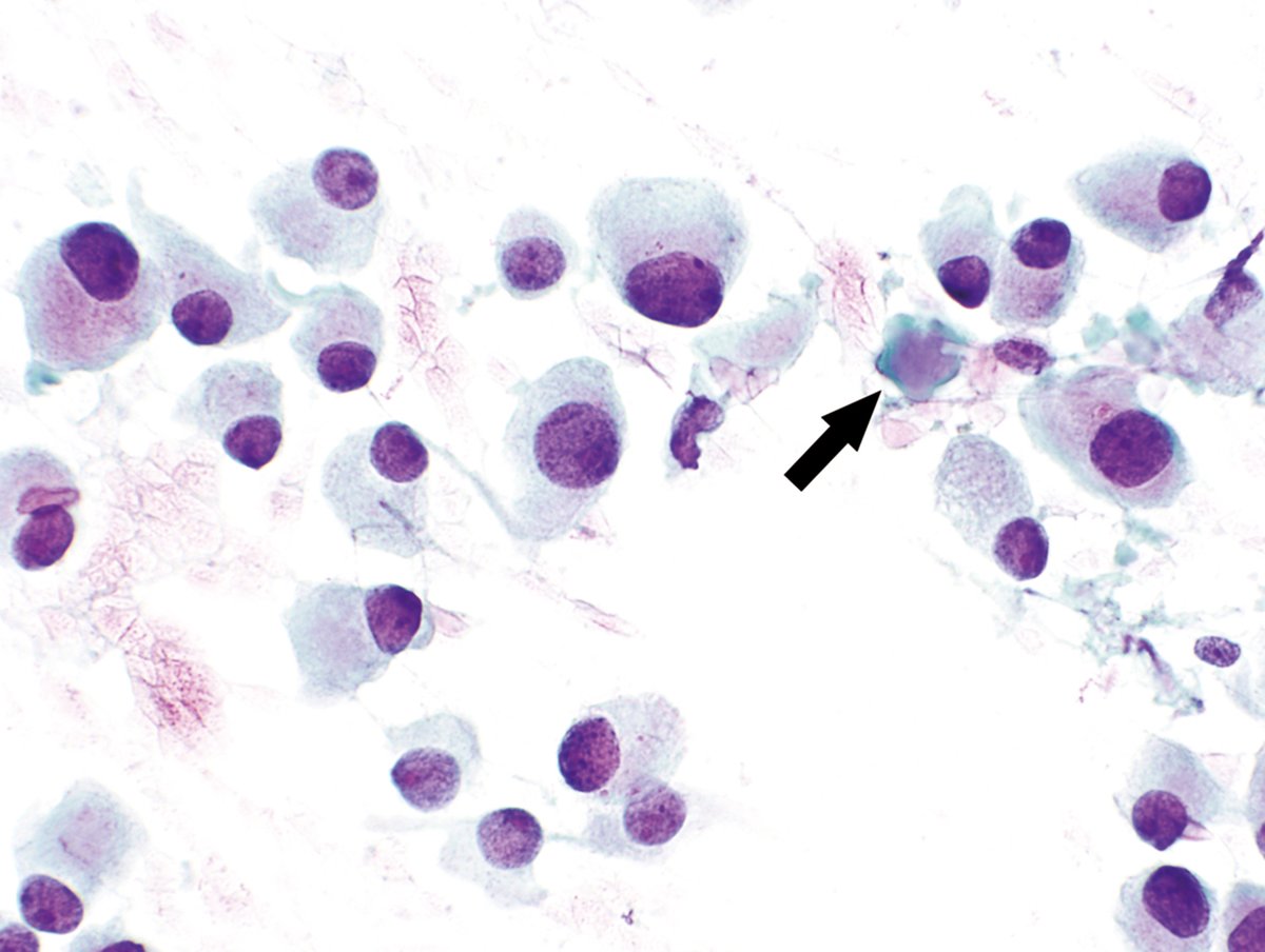 Lola Lozano (@mdlozanoe) on Twitter photo Nice plasmacytoid morphology in a medullary thyroid carcinoma. Lucky to find a little bit of amyloid
<a href="/IACytology/">International Academy Cytology</a> <a href="/EfcsYoung/">Young EFCS</a> <a href="/SECitologia/">Sociedad Española de Citología</a> <a href="/SEAP_IAP/">SEAP-IAP</a> #TBSRTC Nice plasmacytoid morphology in a medullary thyroid carcinoma. Lucky to find a little bit of amyloid
<a href="/IACytology/">International Academy Cytology</a> <a href="/EfcsYoung/">Young EFCS</a> <a href="/SECitologia/">Sociedad Española de Citología</a> <a href="/SEAP_IAP/">SEAP-IAP</a> #TBSRTC
