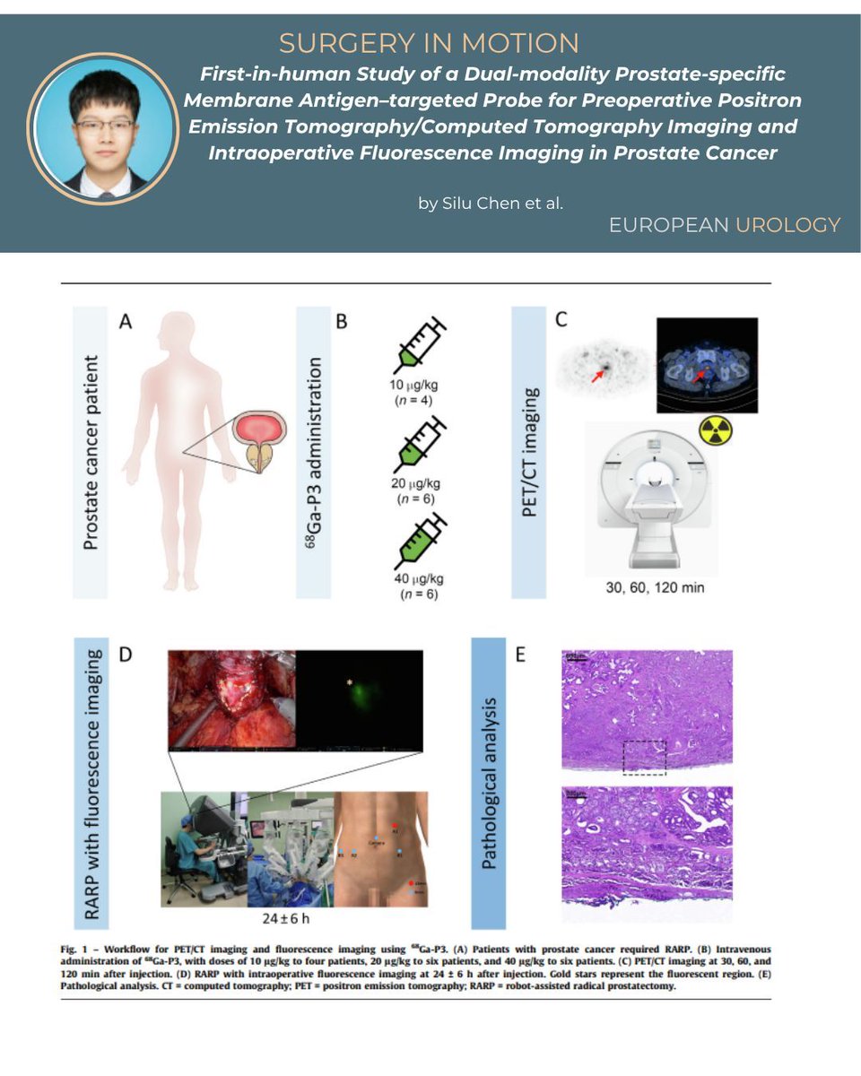 🚨 First-in-human study of a dual-modality PSMA-targeted probe (⁶⁸Ga-P3) for prostate cancer surgery now published in European Urology.
🔬 Combines PET/CT pre-op staging with real-time fluorescence guidance during RARP.
💡 Accuracy up to 92.3%, zero AE. Game-changer?
📖Check