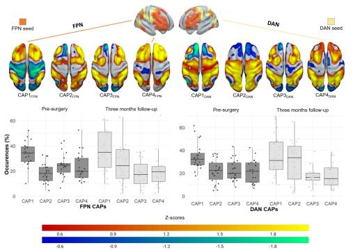 Journal of Neuro-Oncology (@jneurooncol) on Twitter photo Saviola et al. <a href="/FrancescaSavio9/">Francesca Saviola</a> <a href="/SSarubbo/">Silvio Sarubbo, MD PhD</a> showed that presurgical dynamic properties of executive networks, especially fronto-parietal network, can predict short-term attention deficits and recovery after glioma resection. #JNO
Read more:link.springer.com/article/10.100… Saviola et al. <a href="/FrancescaSavio9/">Francesca Saviola</a> <a href="/SSarubbo/">Silvio Sarubbo, MD PhD</a> showed that presurgical dynamic properties of executive networks, especially fronto-parietal network, can predict short-term attention deficits and recovery after glioma resection. #JNO
Read more:link.springer.com/article/10.100…