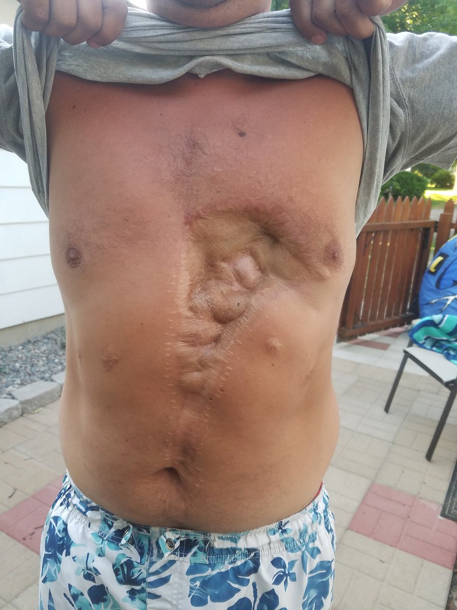 MnDPS_DPS's tweet image. “I made a mistake — one little mistake that almost killed me.”
Nick Beheng had used fireworks since he was a a child, but one mistake nearly cost him his life.
Hear his story, and the risks you face if you choose to use fireworks: dps.mn.gov/news/sfm/dange…