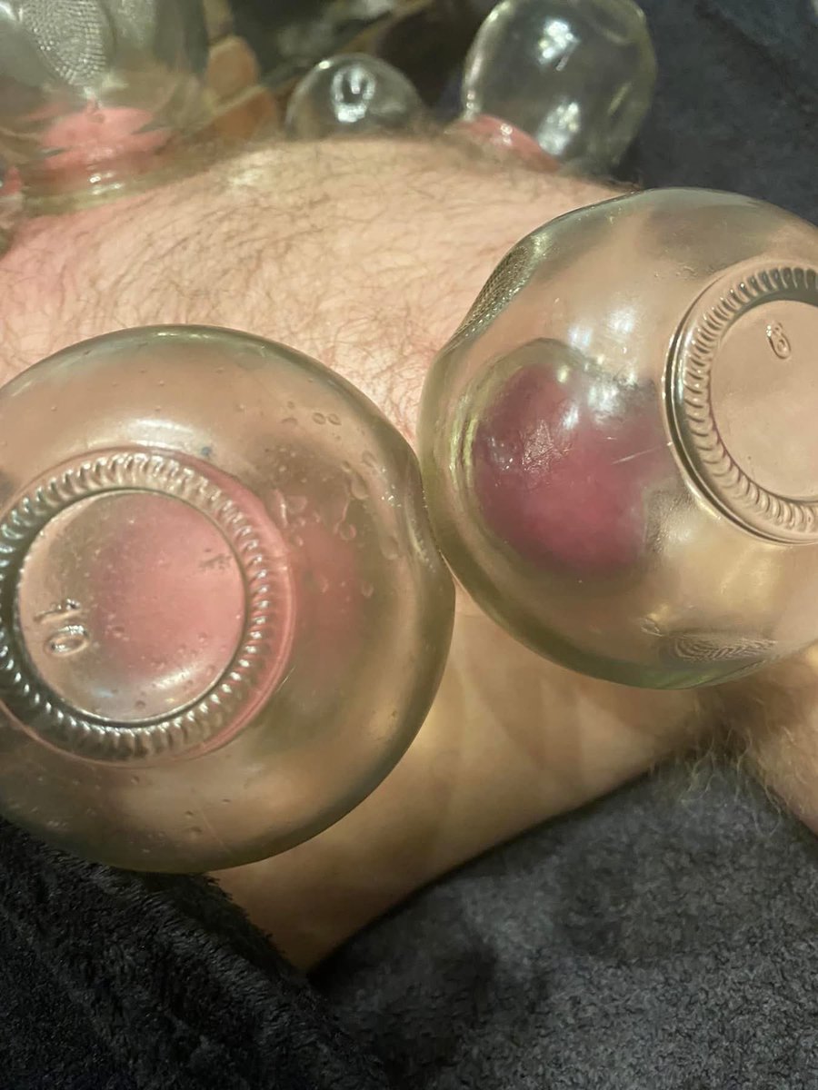 RebeccaTalbot02's tweet photo. Cupping therapy for a client last night .. https://t.co/8M1hPxCChs