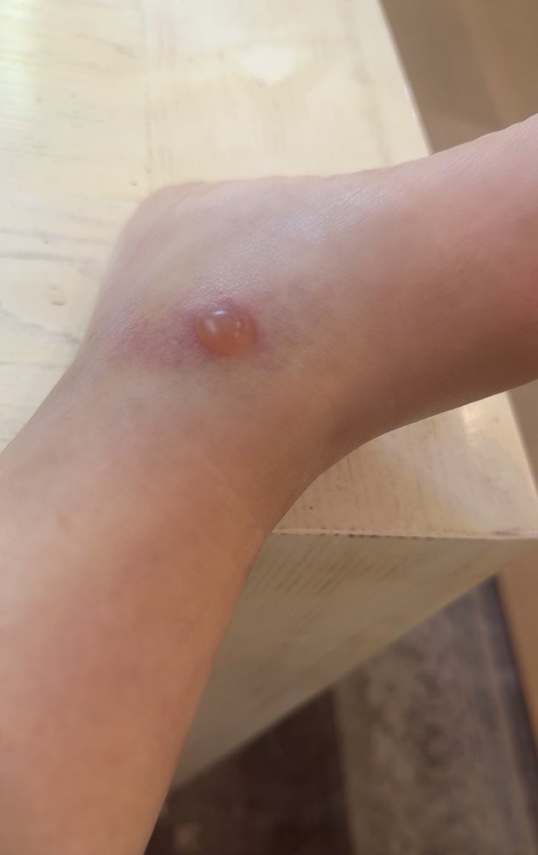 My mom’s spider bite is so gnarly 🕷️