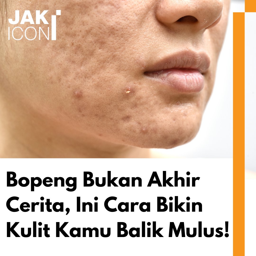 jak_icon's tweet photo. Jakizen, jangan sedih kalau kulitmu bekas jerawatan dan bopeng—ada banyak solusi dari peeling sampai laser yang bisa bantu kamu tampil pede lagi! 💉💆‍♀️ https://t.co/EBbP3TMLrf