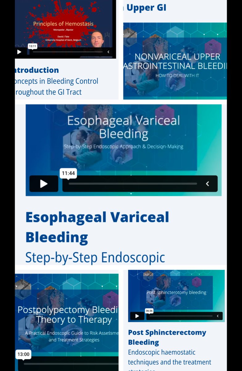 Srisha_Hebbar's tweet image. ESGE academy video journal.Issue 2 GI bleeding . Please log into @ESGE_news for a new set of practical videos. We have contributed to post sphincterotomy bleeding with cased based scenarios @djtate