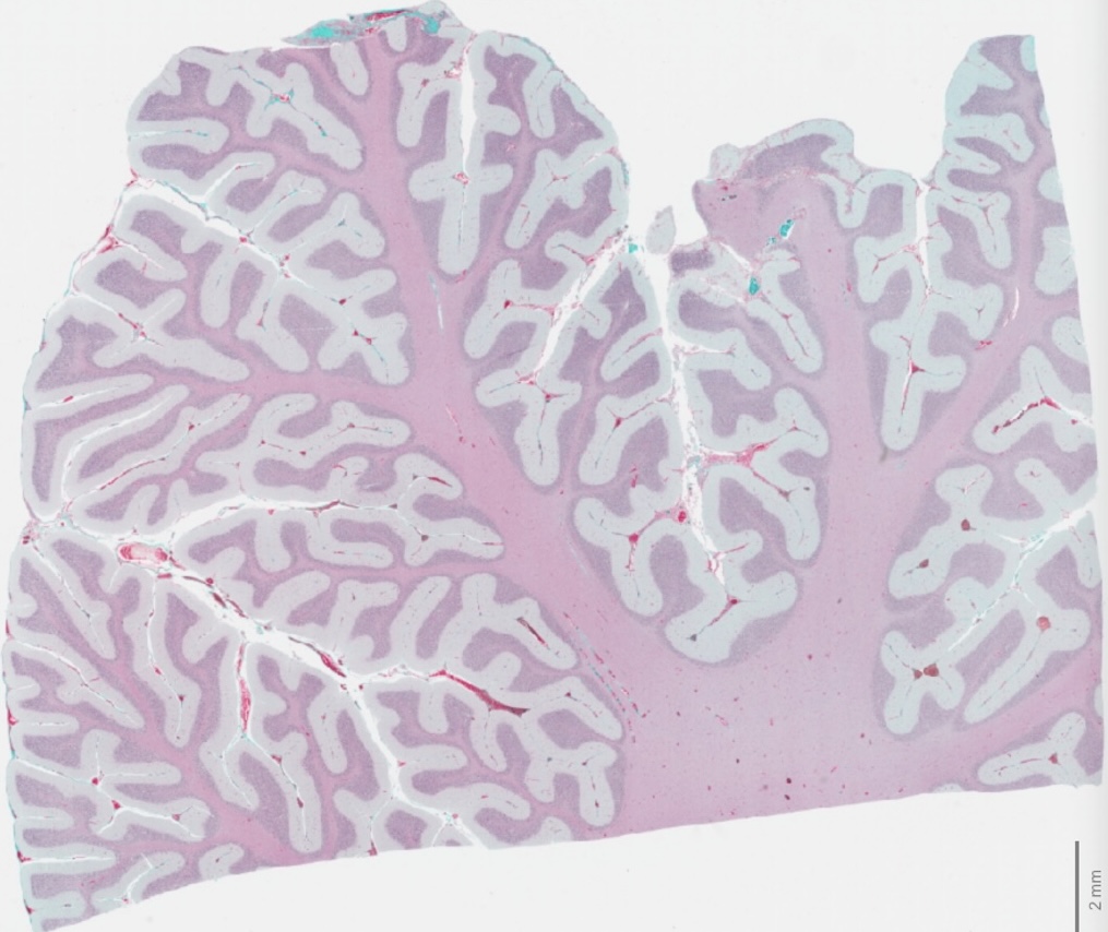 WEHI_research's tweet image. A study has found a promising new way to attack high-grade gliomas (HGG), by targeting the cells surrounding a tumour.
The brilliant findings, led by @drmistyjenkins, @thezoeday and Dr Ryan Cross are now published in Nature’s npj Precision Oncology.
nature.com/articles/s4169…