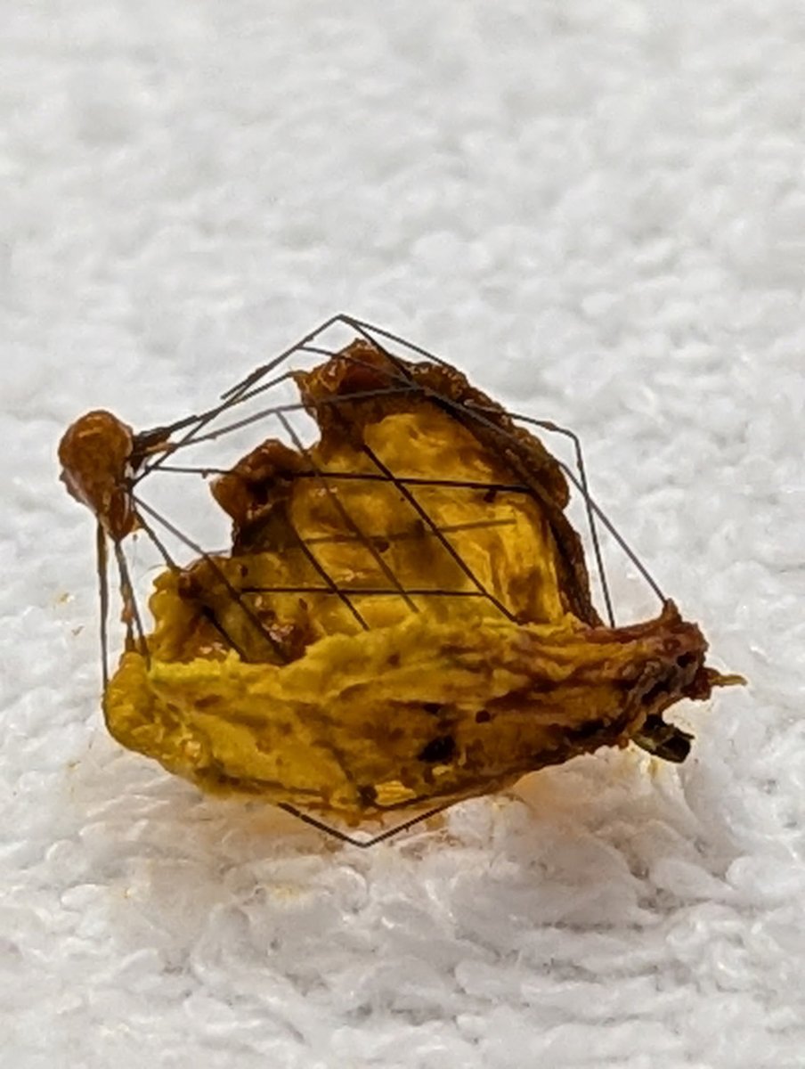 Douglas G. Adler MD, FASGE, FACG, AGAF (@douglasadlermd) on Twitter photo Patient presented to us more than one year after ERCP at outside hospital. Many stones in the duct as well as a metal Stone basket that had been somehow left behind in his biliary tree! #gitwitter #surgery Patient presented to us more than one year after ERCP at outside hospital. Many stones in the duct as well as a metal Stone basket that had been somehow left behind in his biliary tree! #gitwitter #surgery