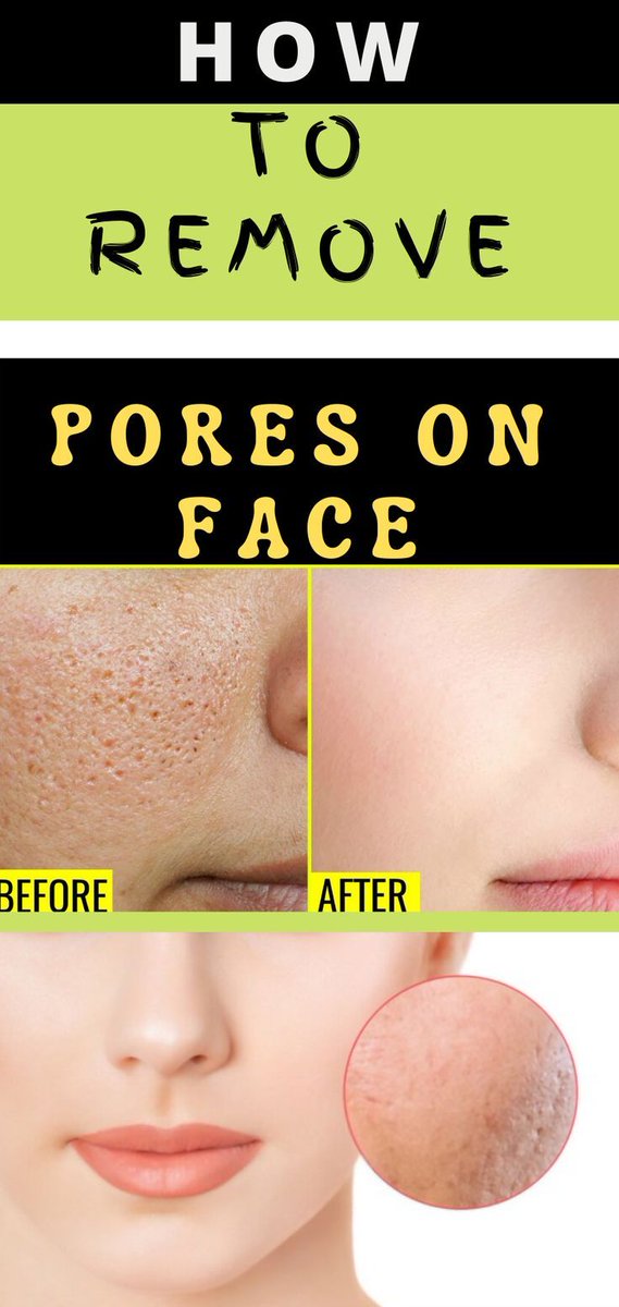 Healthy_Mgz's tweet image. It Only Takes 1 Ingredient To Remove Pores On Your Face At Home 

  💆‍♀️
Full method here:
🔗 healthmgz.com/2022/07/it-onl…

#NaturalSkincare #PoreMinimizer #DIYFacial #SkincareRoutine #ClearSkinJourney #BeautyHacks #HomeRemedy #OneIngredientFix #GlowNaturally #SmoothSkinTips #beauty