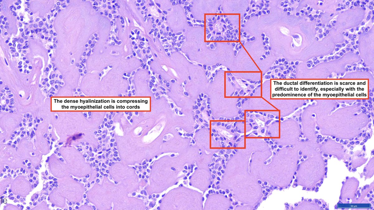 Epithelial myoepithelial carcinoma (EMC)

Low-grade malignant biphasic salivary gland neoplasm characterized by presence of ductal structures composed 2 cell types: Inner (luminal) epithelial cells &amp; outer 
(abluminal) myoepithelial cells.

Synonyms: Clear cell adenoma/ca;