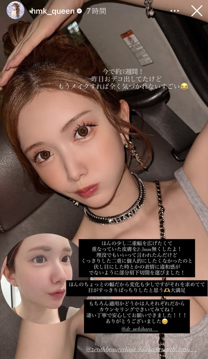 mmmi1000's tweet photo. ひめかちゃんの眉下切開、めっちゃ綺麗👸🫶🏻💕︎︎執刀医の上木原先生、メモメモ✍️ https://t.co/KVBBENmLmR