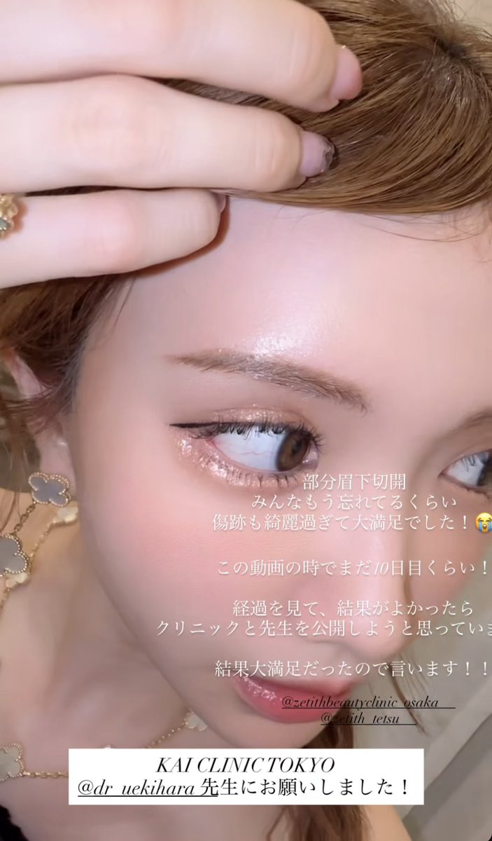 mmmi1000's tweet photo. ひめかちゃんの眉下切開、めっちゃ綺麗👸🫶🏻💕︎︎執刀医の上木原先生、メモメモ✍️ https://t.co/KVBBENmLmR