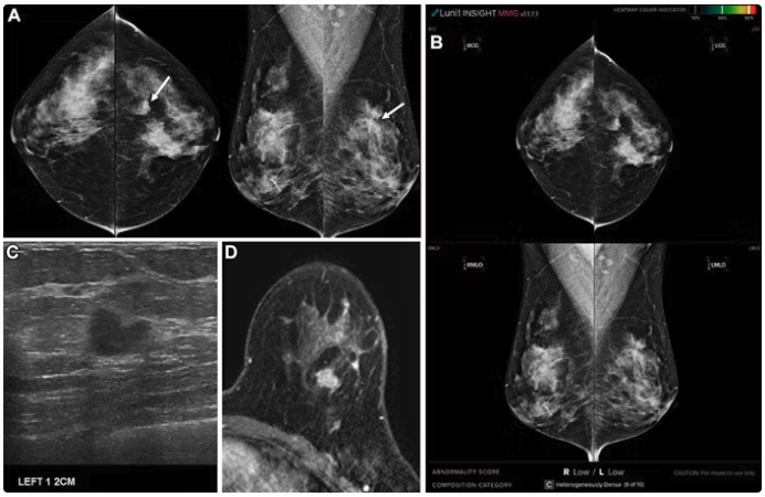 imaging_new's tweet photo. Particular breast cancer characteristics contribute to #AI- mammography misses -- and #radiologists should keep them in mind when using the technology with #mammography, according to a study published June 24 in #Radiology.
Learn more https://t.co/eRcP5dPRib https://t.co/kACXfEtb7A
