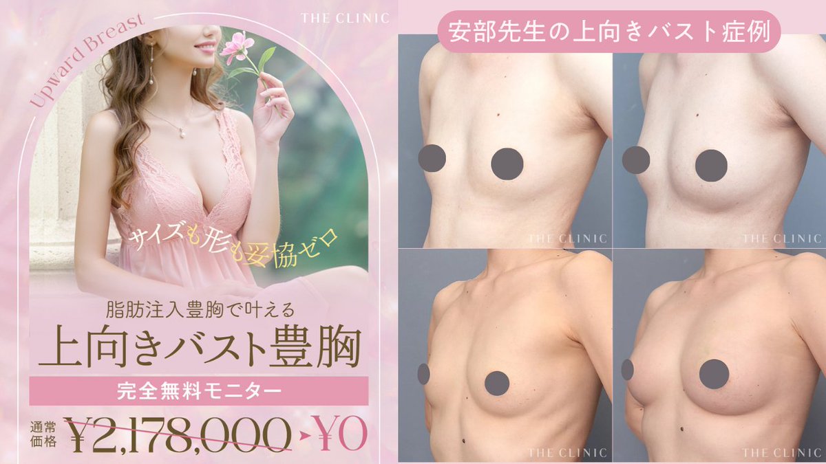 theclinic_abe's tweet photo. ＼ご好評につき、追加応募／
新施術【 #上向きバスト豊胸 】リリース記念 無料モニター募集🎁

☑︎ふっくらデコルテ☑︎そげないバスト脇☑︎立体的な下乳ボリューム
ナチュラル美乳の3️⃣条件を脂肪注入豊胸で叶えます💪

対象クリニック：📍THE CLINIC 大阪院

応募方法は、アカウントフォローしてから、リポスト、いいねお願いします😎
自動DMが届きますのでそちらからご応募お待ちしております！
※自動DMが送られてこない場合は、お手数ですがコメントかDMにメッセージください。

ご応募締め切りは、7/31(木)です！
皆さまのご応募お待ちしております！

#豊胸 #脂肪豊胸 #脂肪注入豊胸 #豊胸モニター