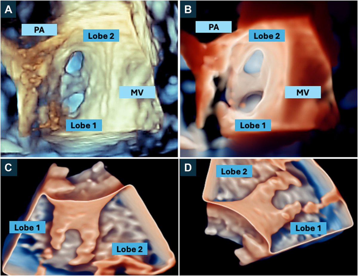 VLSorrellImages's tweet image. #JADEL 

New in CASE @CASEfromASE 
&quot;Double-Trouble&quot;

Outstanding, high quality 3DE TEE images of the bi-lobed LAA and demonstration of dual LAAO device.

Read and learn here:
doi.org/10.1016/j.case…

@ASE360